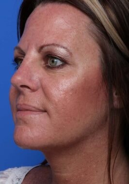 Case # 3 after photo