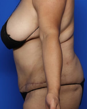 Case # 42 after photo