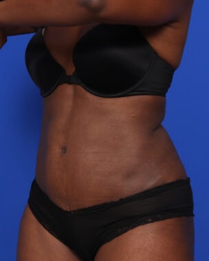 Case # 15 after photo