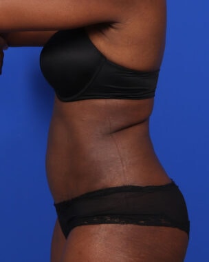 Case # 15 after photo