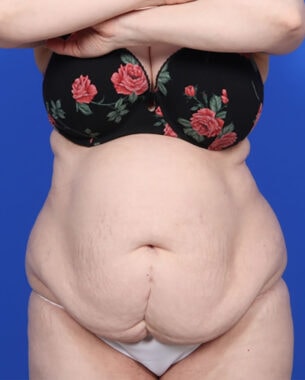 Case # 14 before photo