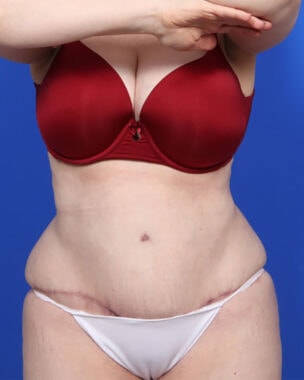 Case # 14 after photo