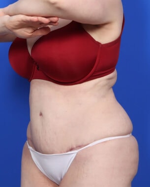 Case # 14 after photo