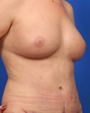 Case # 40 after photo