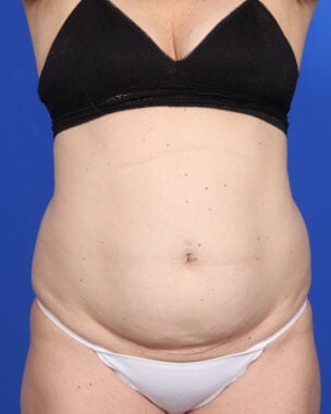 Case # 16 before photo