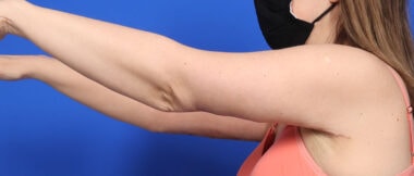 Case # 13 after photo