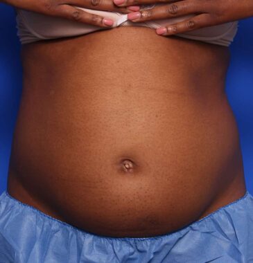 Case # 14 before photo