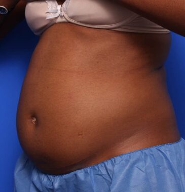 Case # 14 before photo