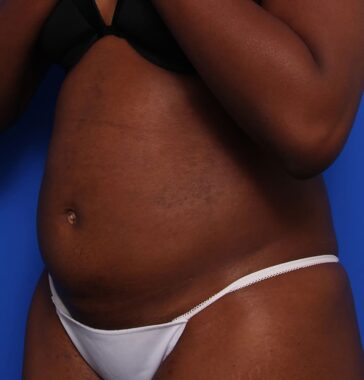 Case # 14 after photo