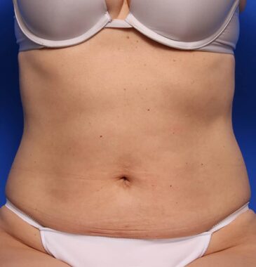 Case # 17 after photo