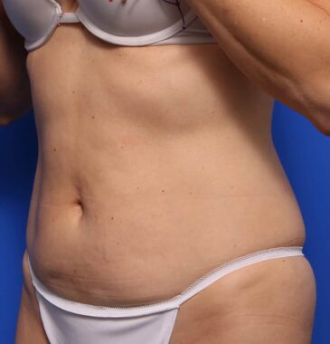 Case # 17 after photo