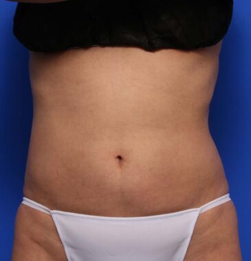 Case # 23 after photo