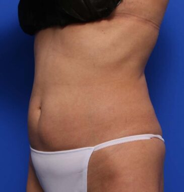 Case # 23 after photo