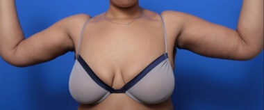 Case # 1 after photo