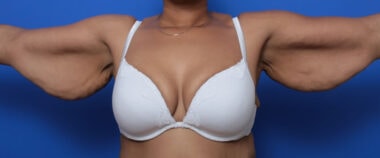 Case # 1 before photo