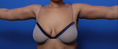 Case # 1 after photo