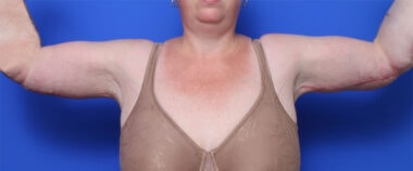 Case # 3 after photo