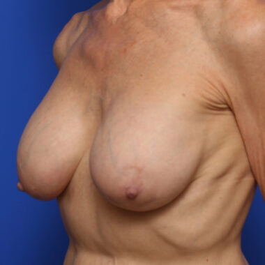 Case # 16 after photo