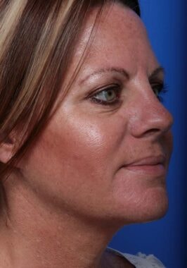 Case # 3 after photo