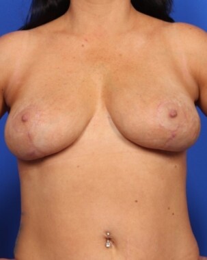 Case # 23 after photo