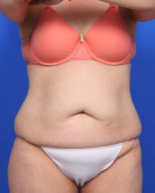 Case # 46 before photo