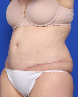 Case # 46 after photo