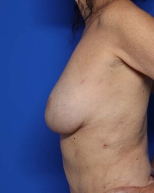 Case # 17 after photo