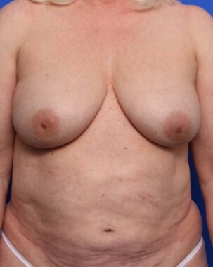 Case # 18 after photo