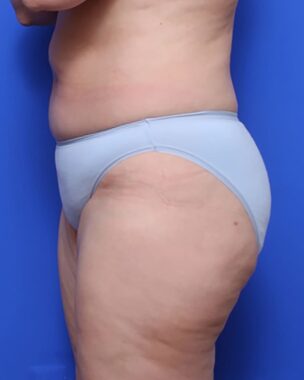 Case # 12 after photo